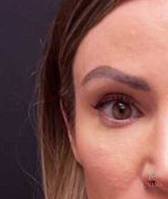 Блефаропластика после